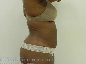 americanlipocenters_90.jpg